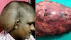 Mosorur Ltd, Man let massive head tumor grow for 20 years over alleged fear of surgery