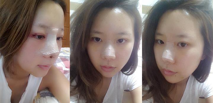 Ngọc Anh sau 5 ngày nâng mũi