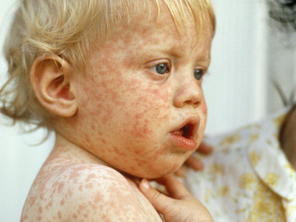 I had measles as a kid am 