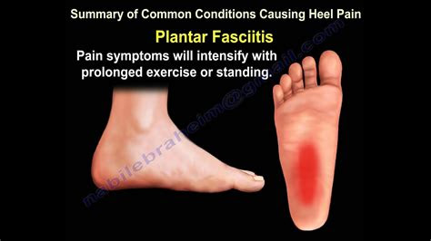 Plantar fasciitis is a painful inflammation of the plantar fascia, a fibrous band of tissue on the bottom of the foot that helps to support the arch. Heel Pain & The Baxter's Nerve - Everything You Need To