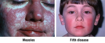 What Does Rubeola (Measles) Look Like?