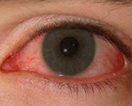 眼も紫外線には注意しましょう 高松ひまわり眼科