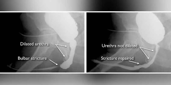 Prostate Cancer Treatment Cost In Delhi / Urethral Stricture Reconstruction Surgery Treatment in : Prostate cancer is a common type of cancer in men, according to the mayo clinic.