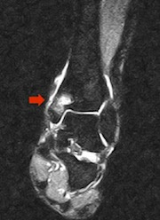 Osteoporosis