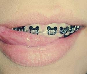 Jovens usam acessórios dentários de maneira irregular (Foto: Aparelhos Diferenciados/Divulgação/Facebook)