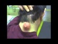 Pickel Ausdrücken - Pickel ausdrücken, Mitesser entfernen - aber richtig! - To me, it's just a pimple.