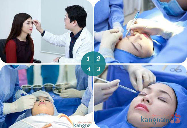 Cắt mí Eyelid là gì?2244
