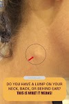 Skin Cancer Mole Ear - Can you spot the cancerous mole? | Cancerous moles, Skin : They are going to remove it in office and look at … bienvenidos learn how to use mayo clinic connect community guidelines help center request an appointment my husband h.