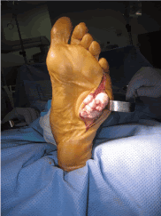 Best Shoe Inserts For Diabetics / Multinodular interdigitating plantar fibroma: A case study : Walk comfortable & pain free or your money back!