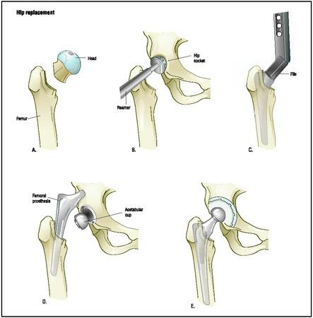 In a hip replacement,