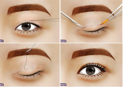Nên cắt mí hay bấm mí?2