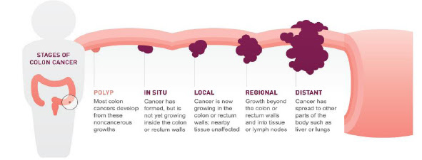 colorectal cancer in malaysia