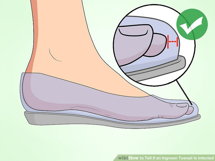 Tell if an Ingrown Toenail Is Infected Step 9.jpg