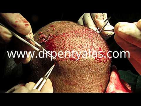 FUE Hair Transplant Process