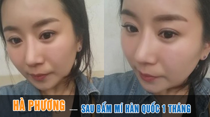 Hà Phương sau 1 tháng bấm mí mắt Hàn Quốc