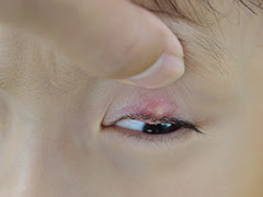 まぶたが腫れた しこりがある 足柄上郡開成町 眼科さくらクリニック