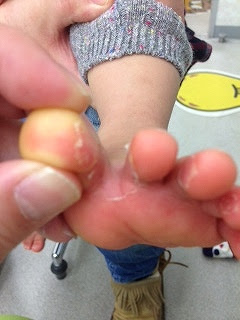 皮膚に白い皮むけ 野田市 小児科 千葉県 こどもの花粉症 こどもの漢方 喘息 アトピー性皮膚炎 アレルギー 結節性痒疹 たんぽぽこどもクリニック