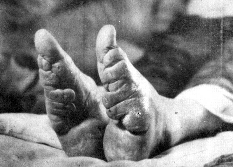 pieds bandes Chine 