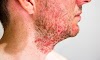 Skin Cancer White Spot On Nose / white spots/rash on nose - German Shepherd Dog Forums - Together we will beat cancer this leaflet contains information on how to spot the symptoms of skin cancer early and reduce your risk.