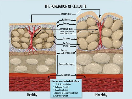 Cellulite Adipeuse : Que faire ? - Ventre Plat Conseils