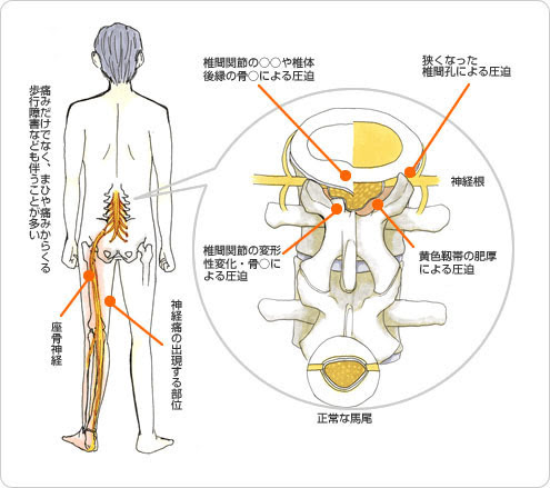 脊柱管狭窄症 しびれ 浜松市の四ツ池reborn整骨院 整体院