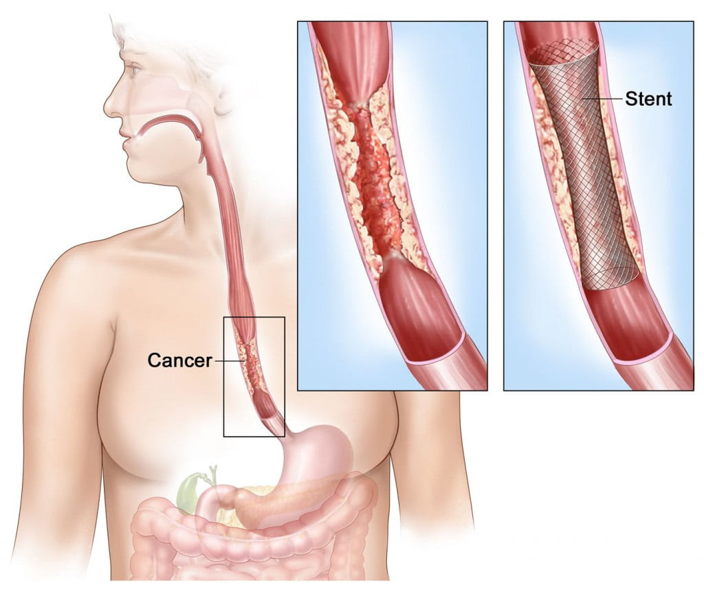esophageal-cancer