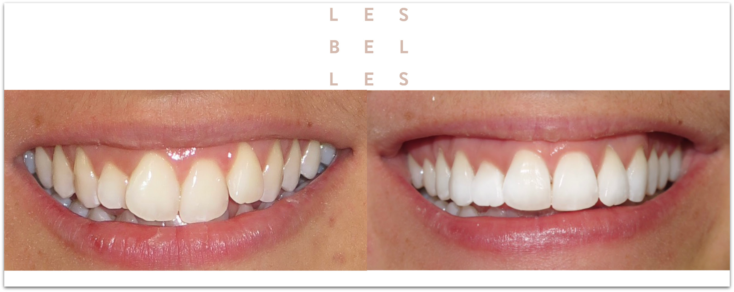 Invislaign Braces | New York, NY