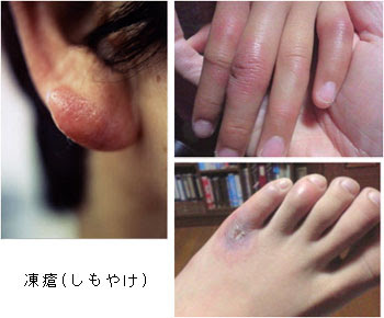 しもやけ 目黒区 都立大学 すみクリニック