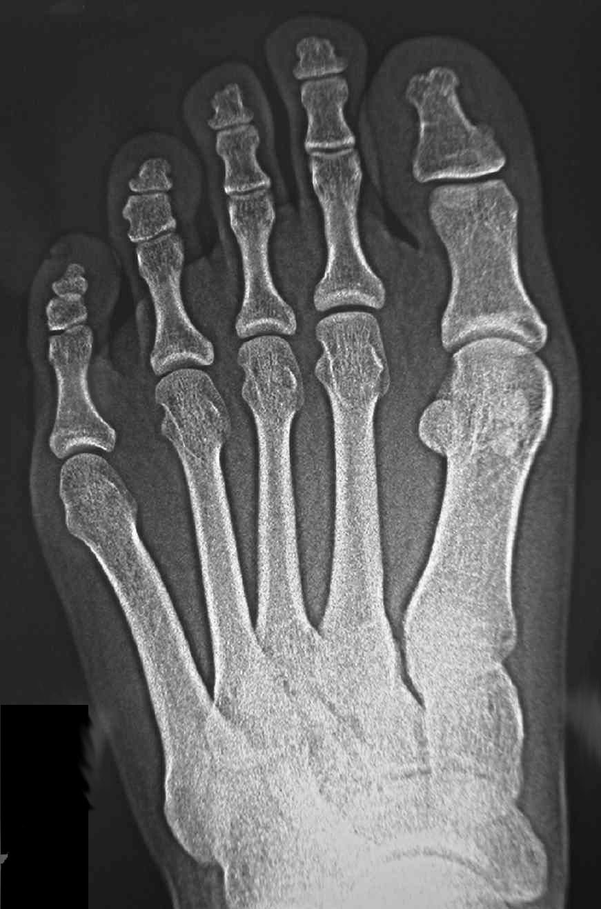 内反小趾に関する質問集