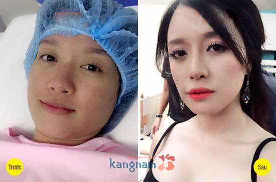 cắt mắt 2 mí Kangnam79-