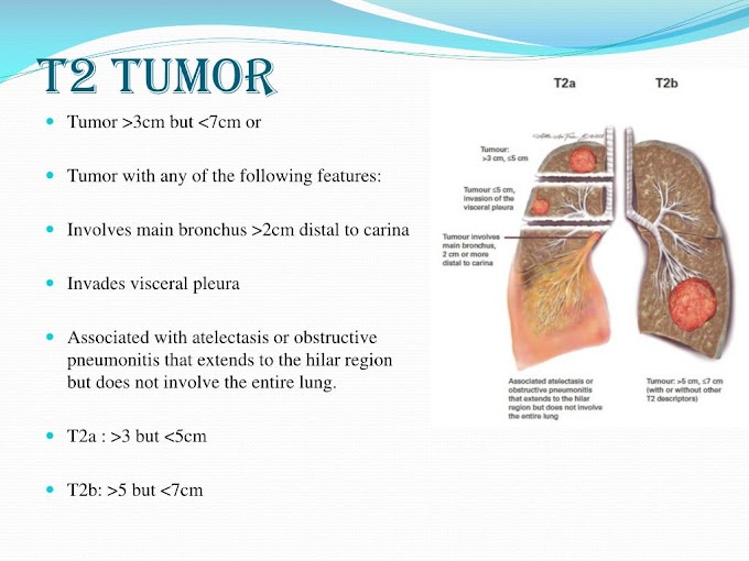 primary lung cancer lymph nodes Stage n3 lymph nodes. (a) axial pet/ct
image of the chest shows a