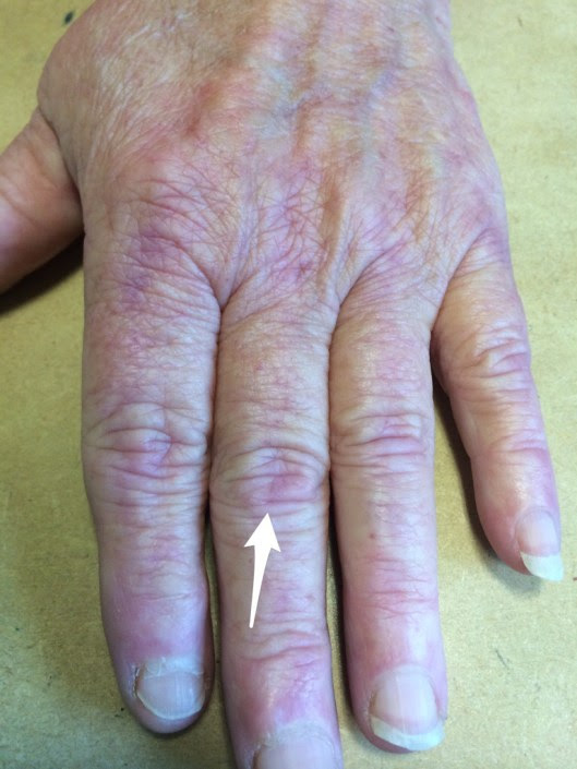 ... should be referred to rheumatology below is blanching under pressure