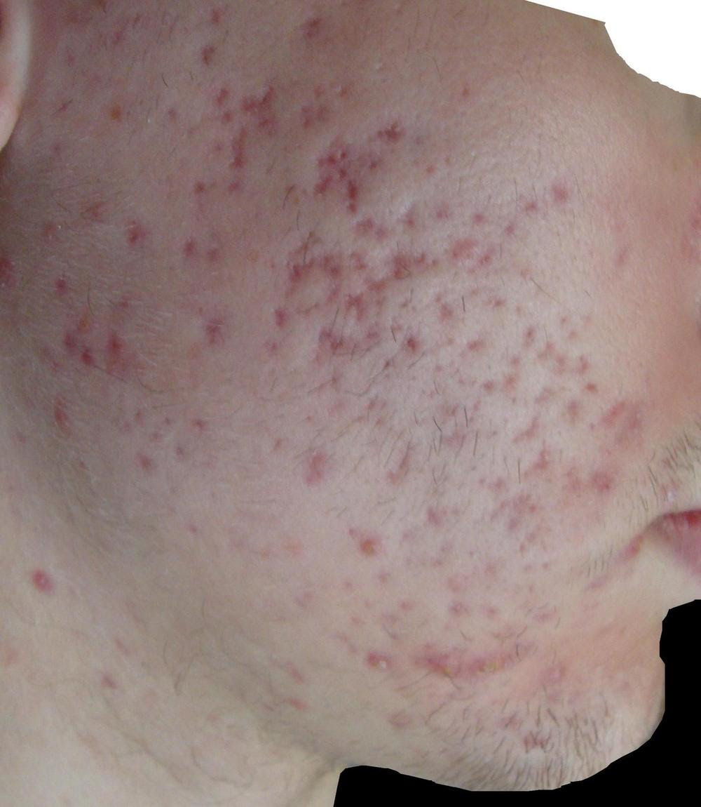 Face+On+Spot+Acne+Scars Red Marks / Scarring - Hyperpigmentation - red 