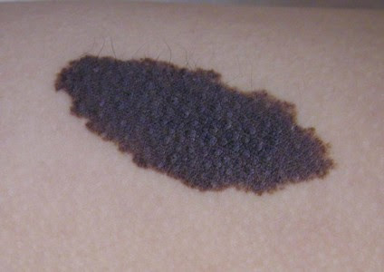 皮膚病 皮膚の病気 ４ 稲葉クリニック 杉並区皮膚科