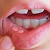 Apthen Zunge / Aphten Auf Zunge : Eine aphthe ˈaftə (transliteration von altgriechisch ἄφθη, vom verb ἅπτω haptō, deutsch ‚entfachen‘) ist eine schmerzhafte, von einem entzündlichen randsaum umgebene schädigung der schleimhaut des zahnfleischs, der mundhöhle einschließlich der lippen, der tonsillen oder der zunge.