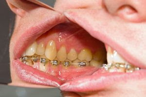 Teeth whitening at home reviews 2013