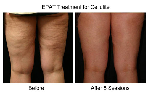 Cellulite Treatment - Radiant Rejuvenation - Seattle