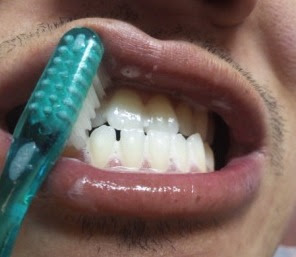 自己責任で行うホワイトニング