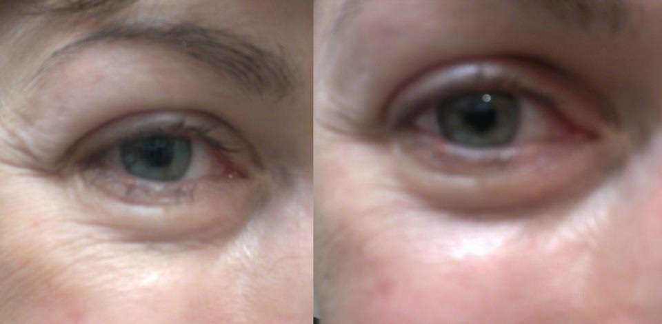 Le Super Soin Contour Des Yeux Pour Les Poches Et Ridules Les Chroniques De Sonia