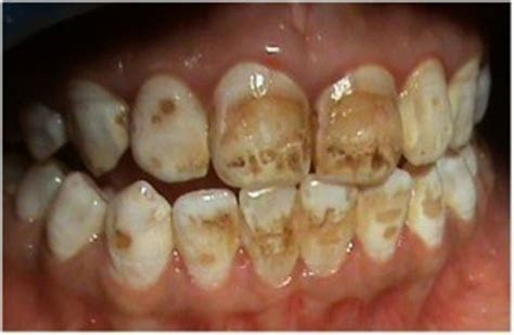 Many bottled water brands have acidic ph levels and added fluoride, which can be damaging to your teeth. Why you should avoid the high fluoride water of Naivasha
