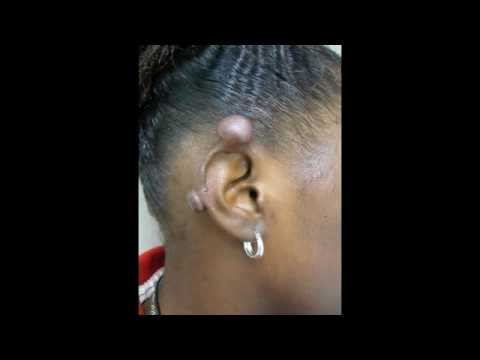 (310) 998-5533 - Dr. Karamanoukian is an expert in difficult keloid scars, 