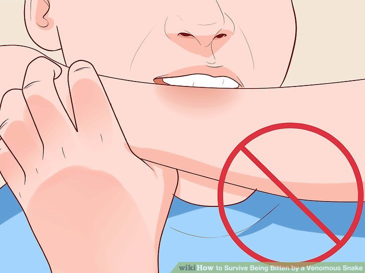 Survive Being Bitten by a Venomous Snake Step 9 Version 2.jpg