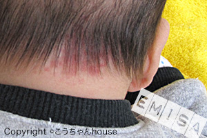 Happy Lens こうちゃんhouse ラッキーベビーの証 ウンナ母斑