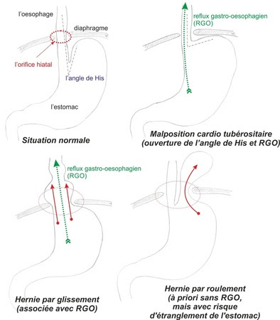Regime hernie hiatale