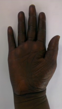 Hand Foot Syndrome Capecitabine Chemotherapy Advice