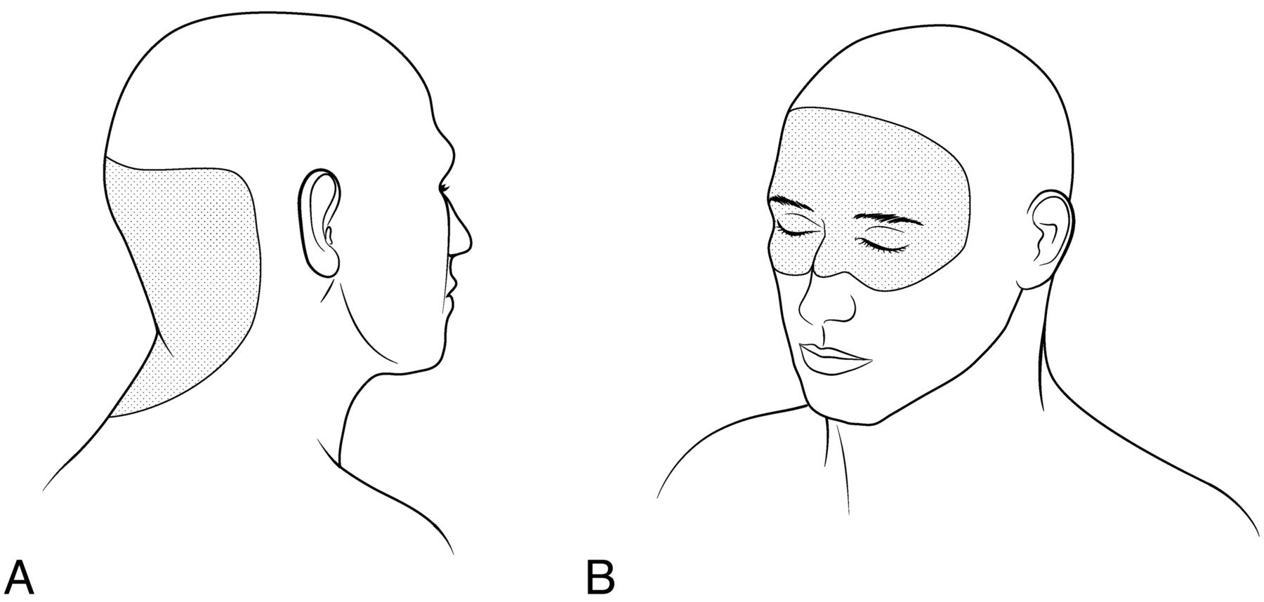 Rebound Intracranial Hypertension A Complication Of Epidural Blood Patching For Intracranial Hypotension American Journal Of Neuroradiology