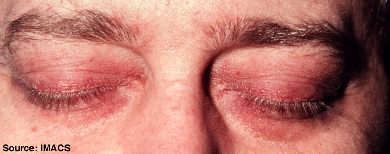 dermatomyositis rash