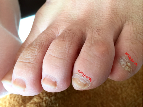 感動 何十年ぶりに足の小指の爪を見た News 新宿 中落合 落合南長崎 のネイルサロン ノエルローズ