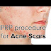Why PRP Treatment is Popular for Hair Restoration