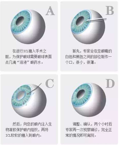 1分钟看懂icl晶体植入术的全过程 我的网站